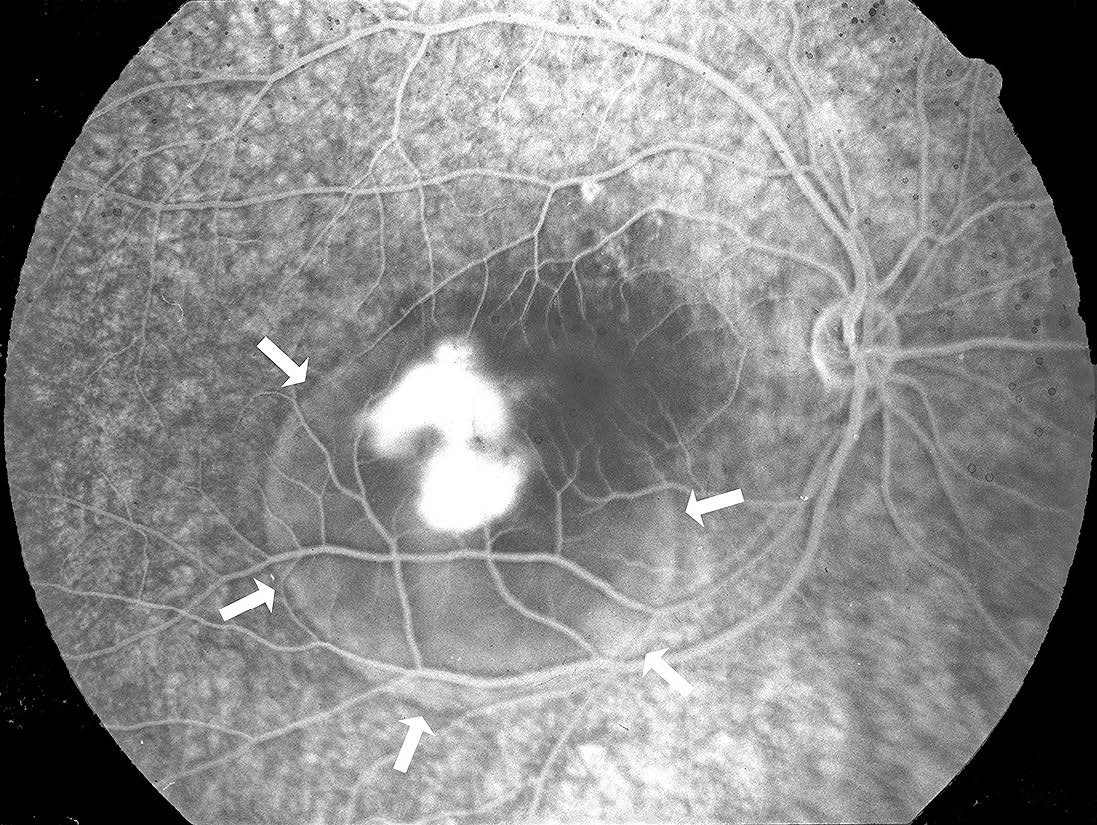 中心性異色症とヘーゼル色の目の違いは何ですか?